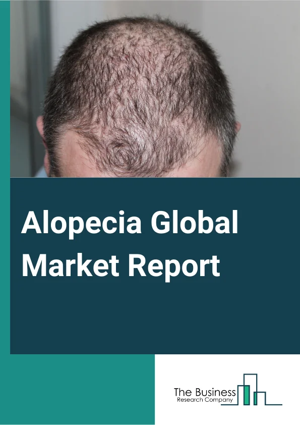 Alopecia Global Market Report 2024 – By Type (Alopecia Areata, Androgenetic Alopecia, Alopecia Totalis, Traction Alopecia, Cicatricial Alopecia, Other Types), By Treatment (Pharmaceutical, Low Level Laser Therapy (LLLT) Devices, Hair Transplant, Regenerative Medicine, Other Treatments), By Gender (Male, Female), By Distribution Channel (Hospital Pharmacies, Retail Pharmacies, Online Pharmacies, Other Distribution Channels), By End-User (Dermatology Clinics, Homecare Settings, Other End-Users) – Market Size, Trends, And Global Forecast 2024-2033