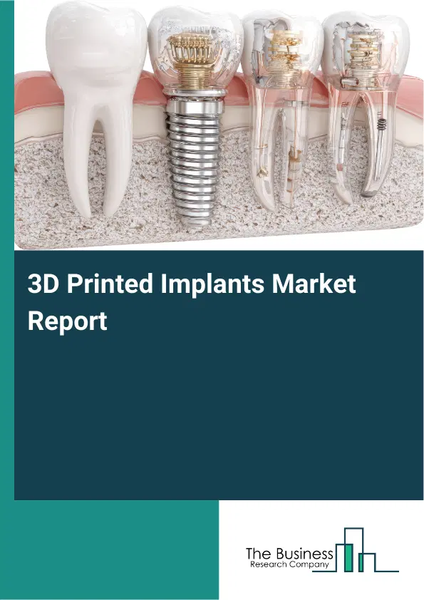 Global 3D Printed Implants Market Report 2026 Global 3D Printed Implants Market Report 2026
