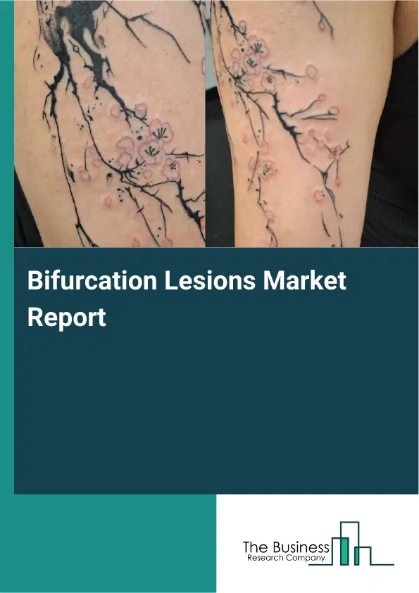Bifurcation Lesions Market Report 2026 Bifurcation Lesions Market Report 2026