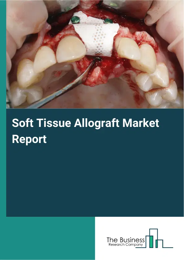 Soft Tissue Allograft Market Report 2026 Soft Tissue Allograft Market Report 2026