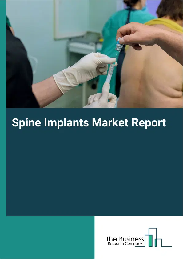 Spine Implants Market Report 2026 Spine Implants Market Report 2026