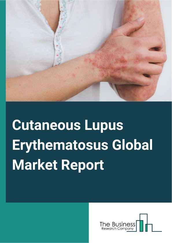 Cutaneous Lupus Erythematosus