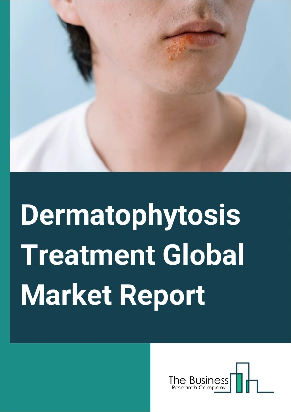 Dermatophytosis Treatment