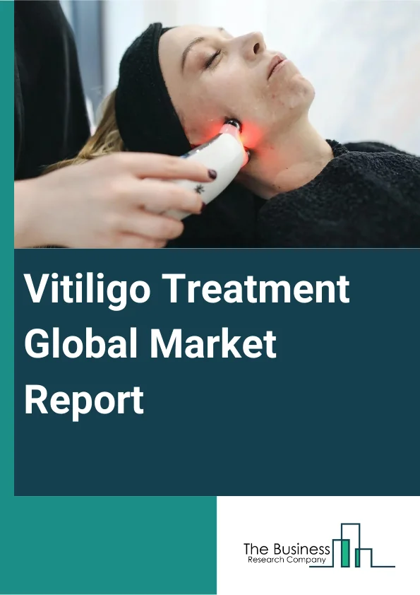 Vitiligo Treatment Market Growth, Latest Trends, Share Analysis, Report